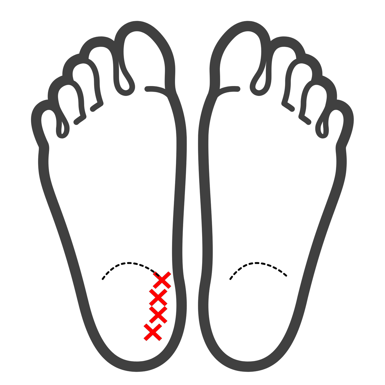 足底の圧痛箇所の図