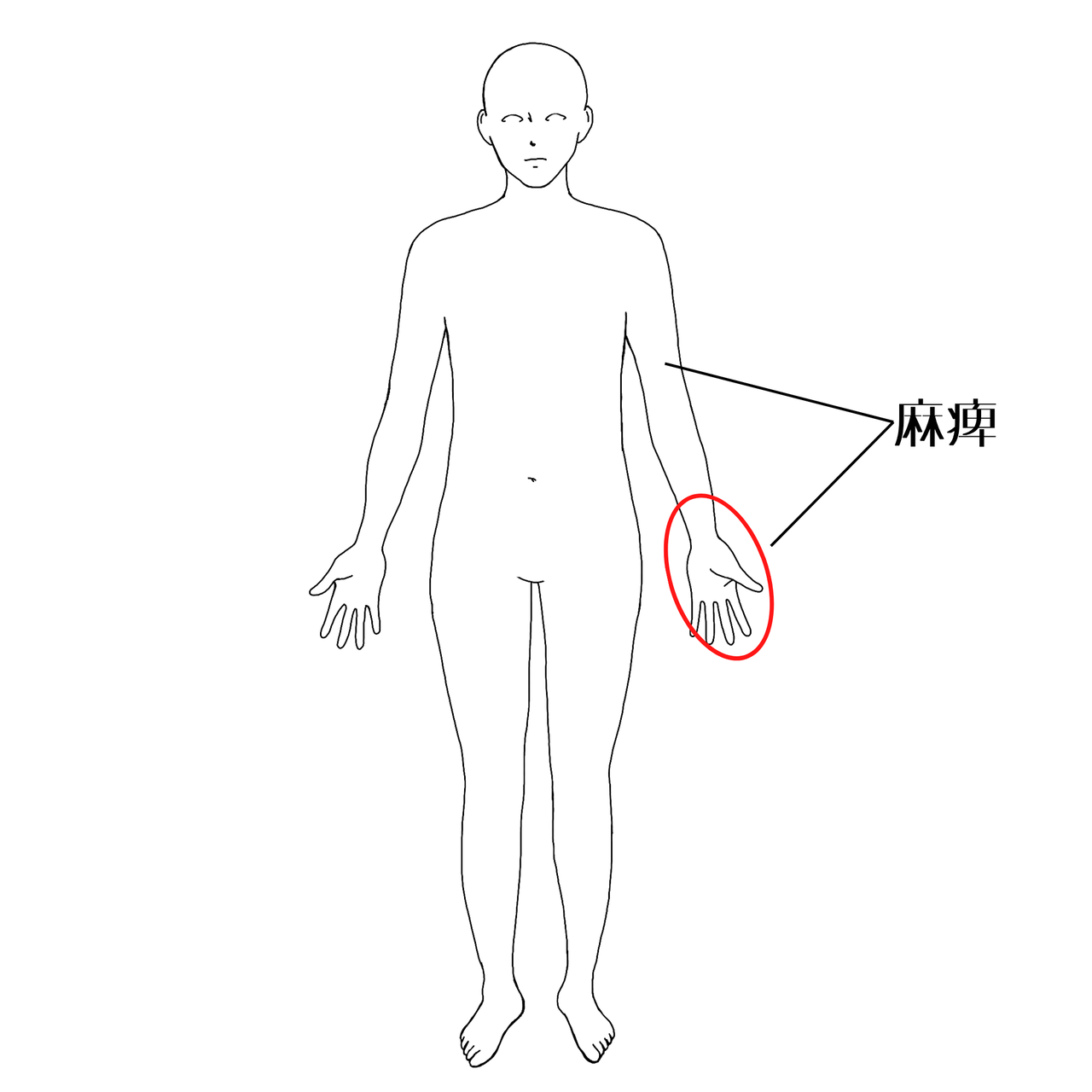 頚椎ヘルニアの症状部位