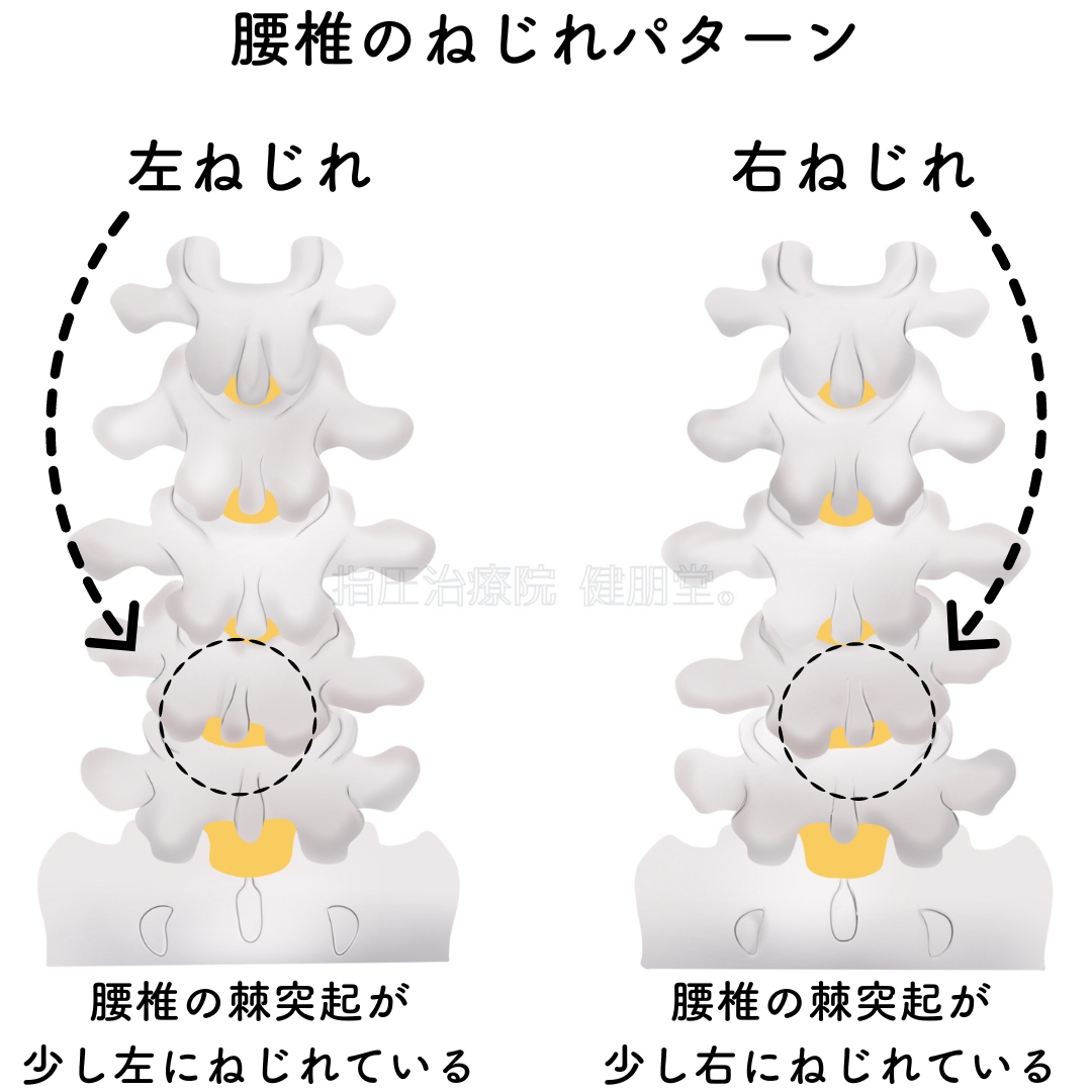 腰椎のねじれの説明