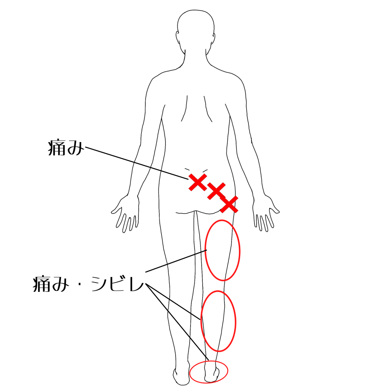 坐骨神経痛の痛みの部位イラスト