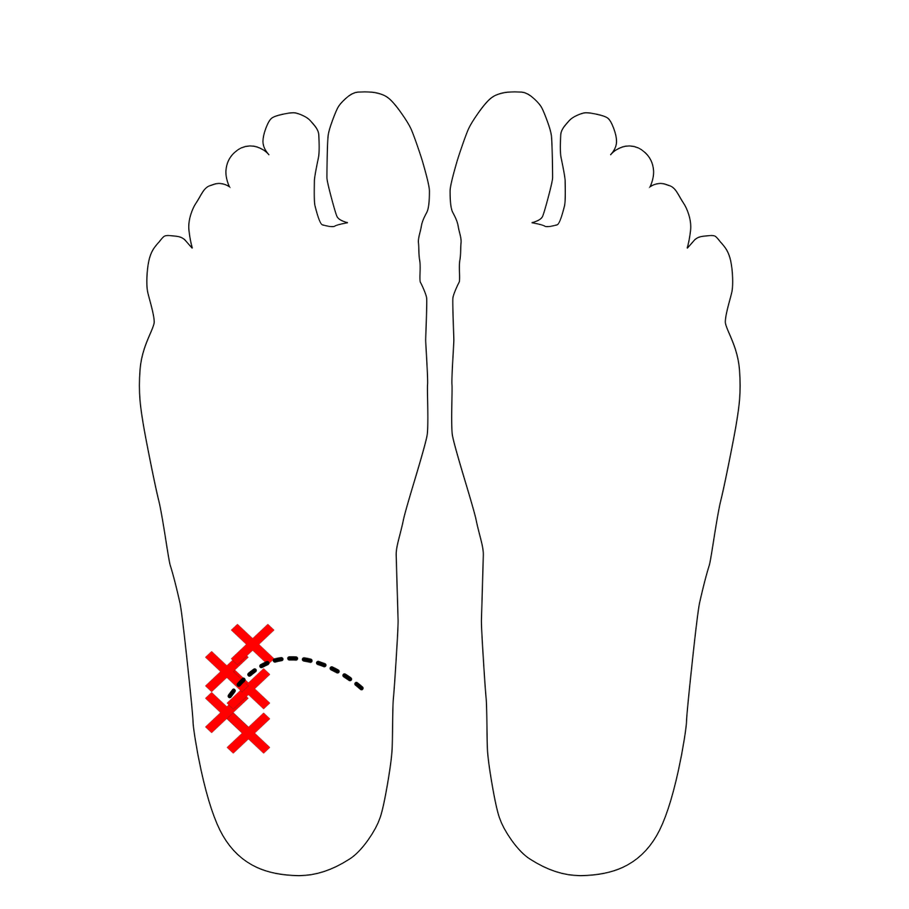 足底の痛みの部位イラスト