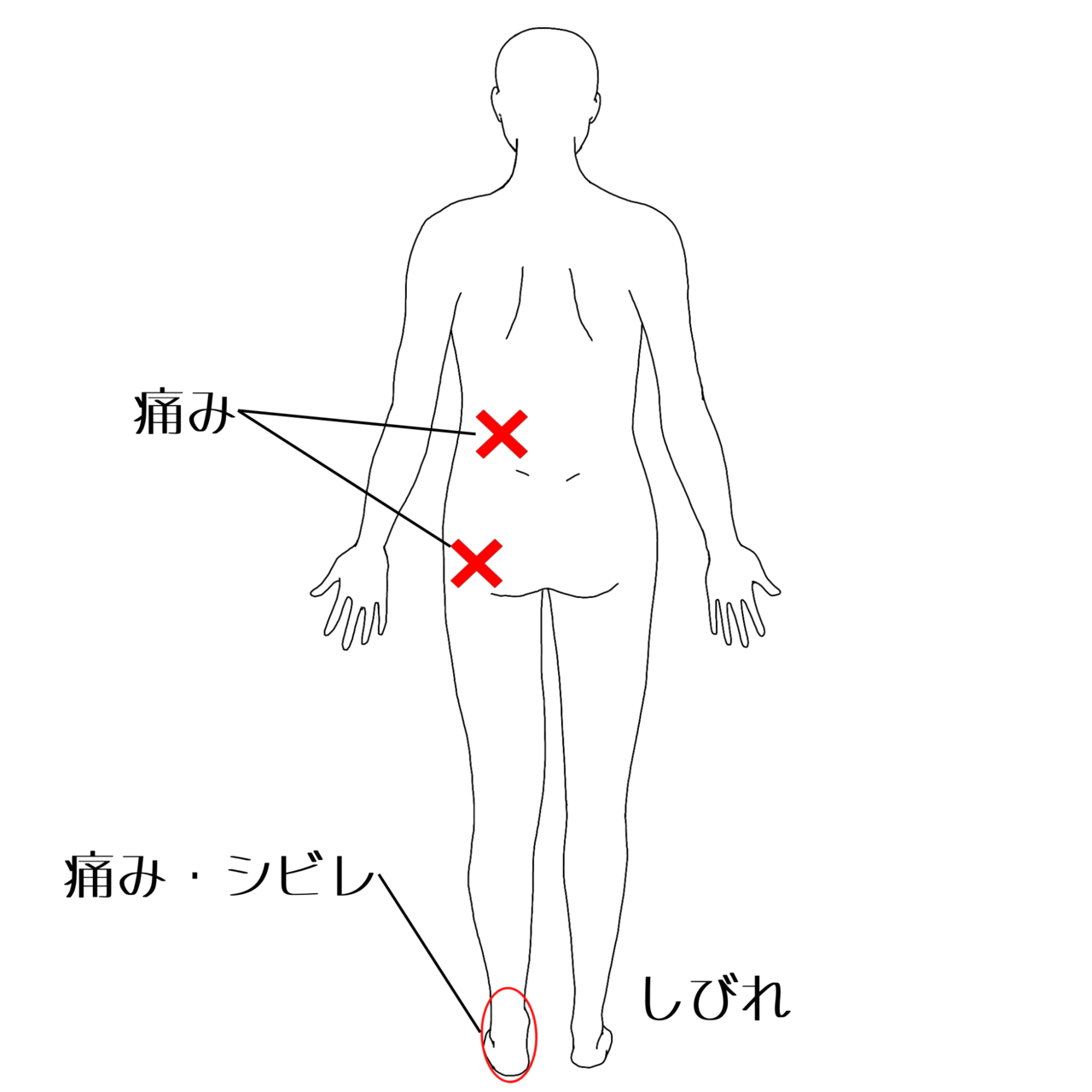 坐骨神経痛の痛みの部位イラスト