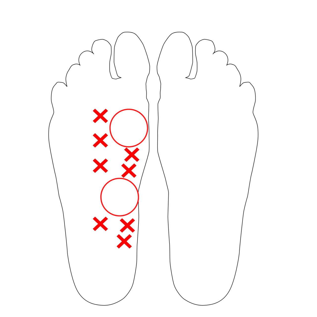 足底の圧痛箇所の図