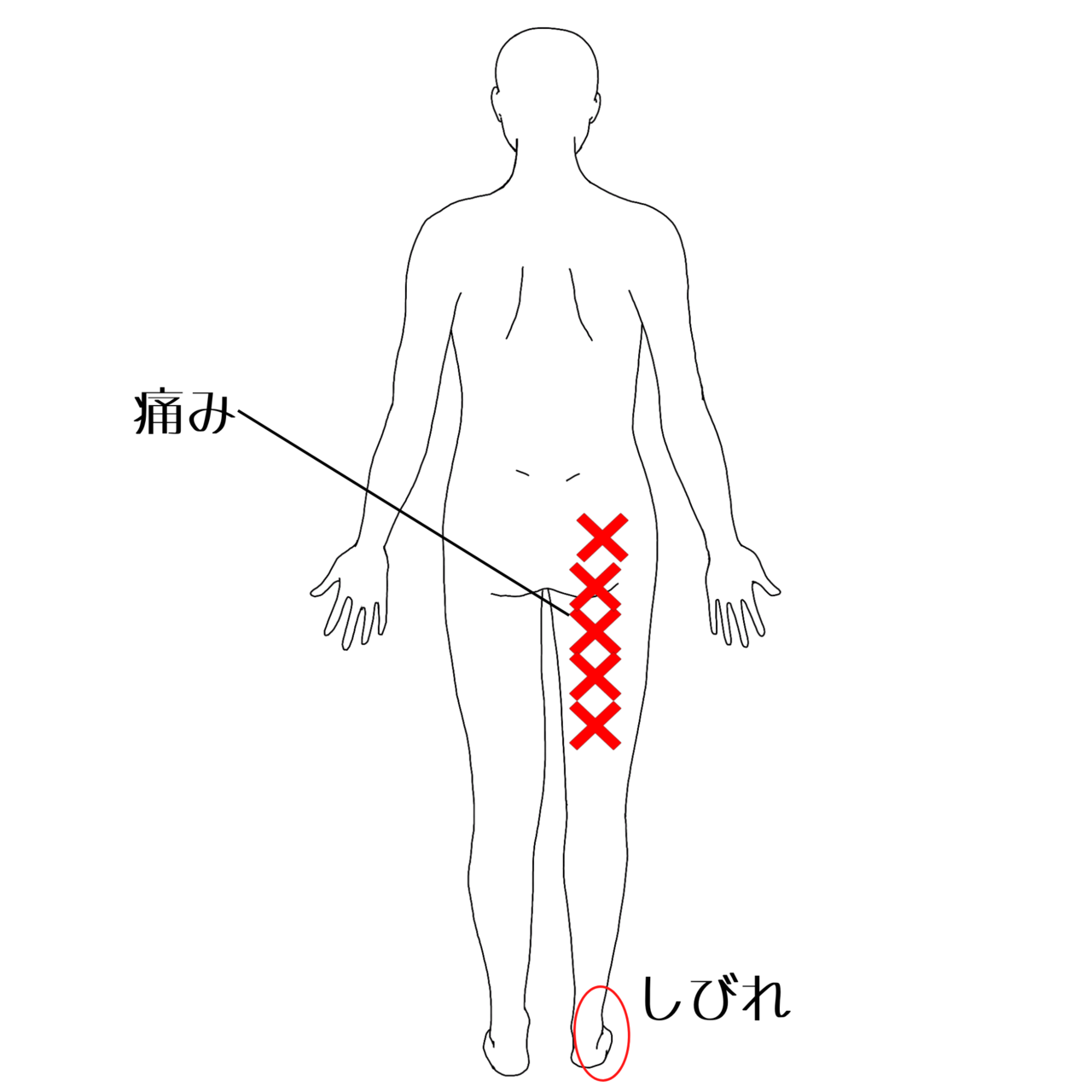 坐骨神経痛の痛みの部位イラスト