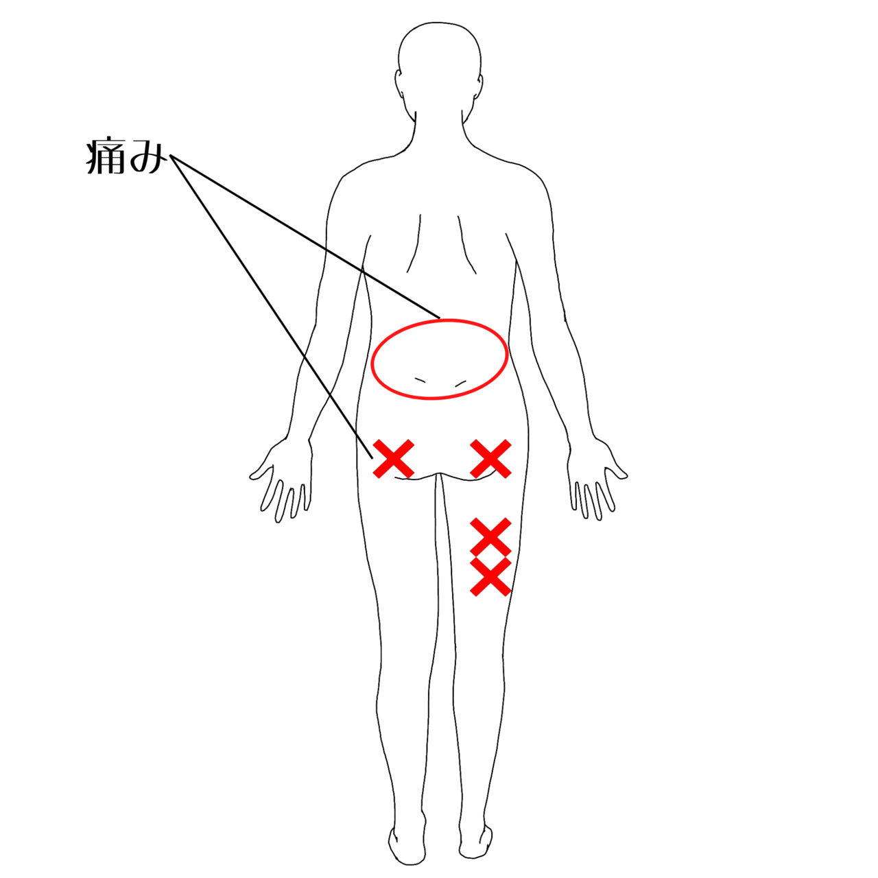 坐骨神経痛の痛みの部位イラスト