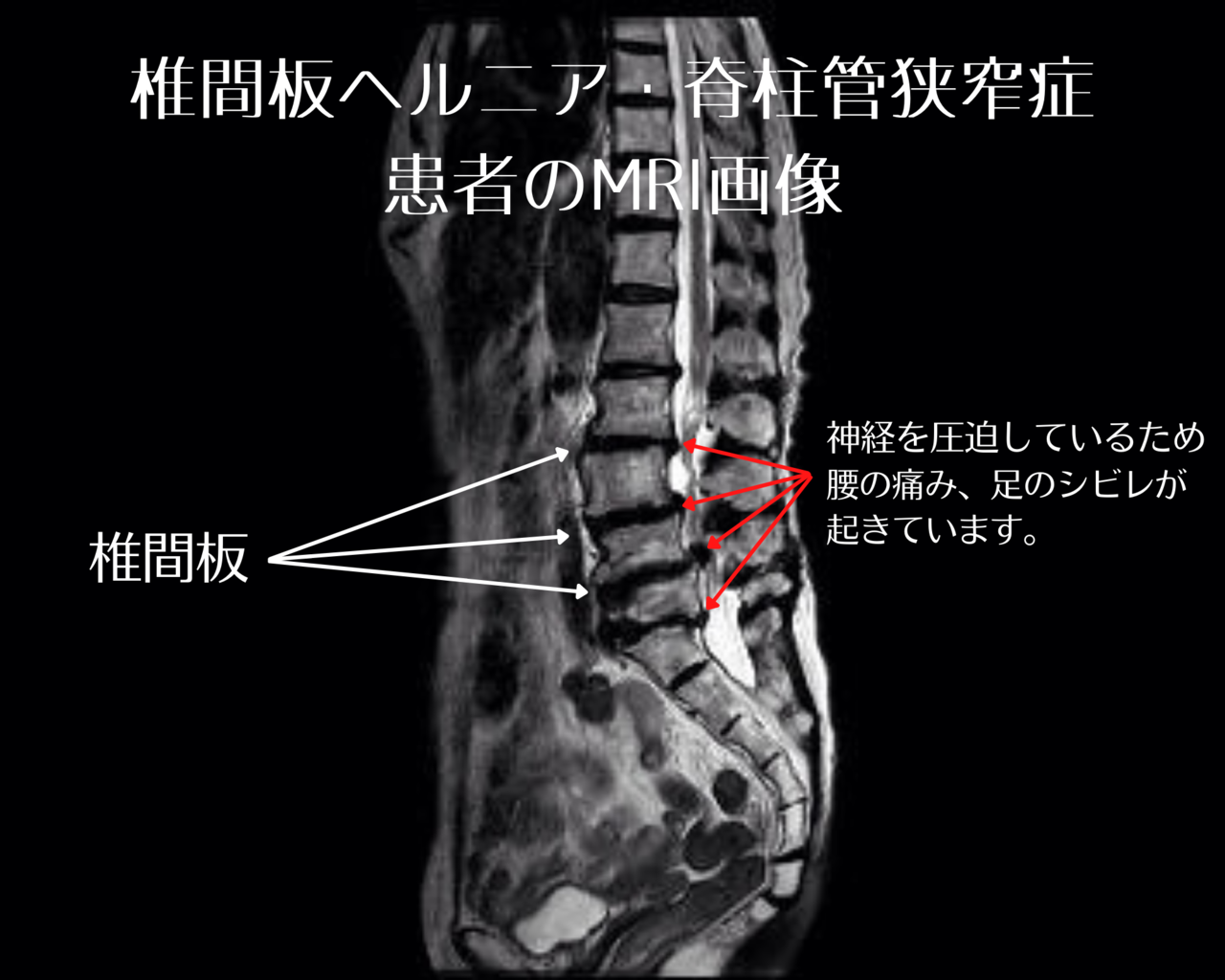 椎間板ヘルニア・脊柱管狭窄症患者のMRI画像