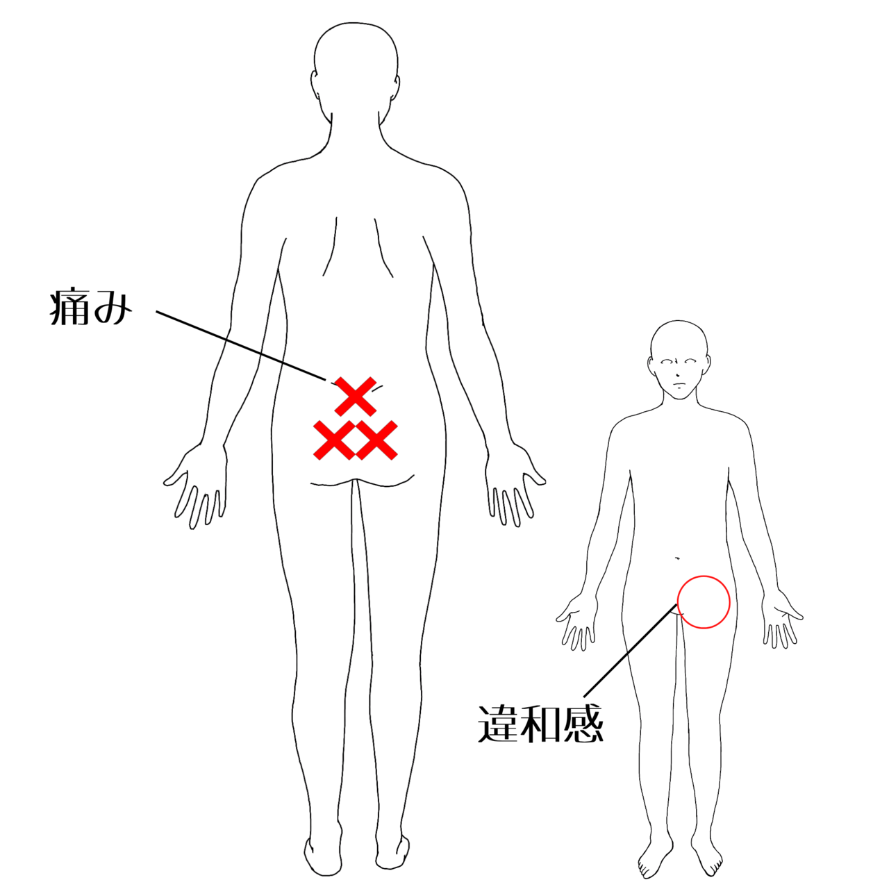 仙腸関節痛の痛みの部位イラスト