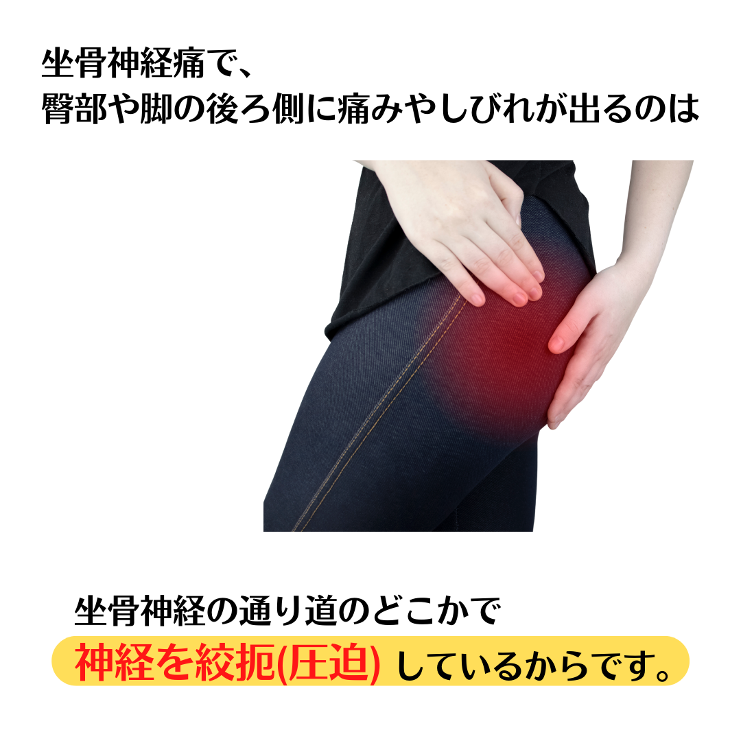 臀部や脚の後ろ側に痛みやしびれが出るのは坐骨神経の通り道で圧迫されるからです。