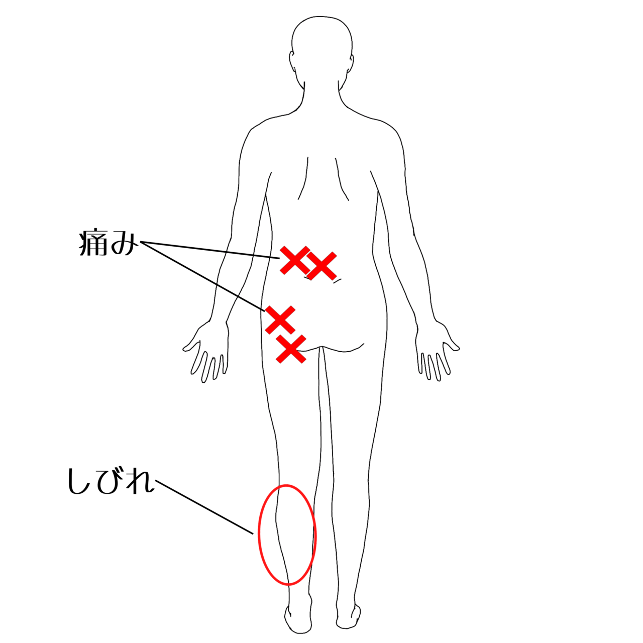坐骨神経痛の痛みの部位イラスト