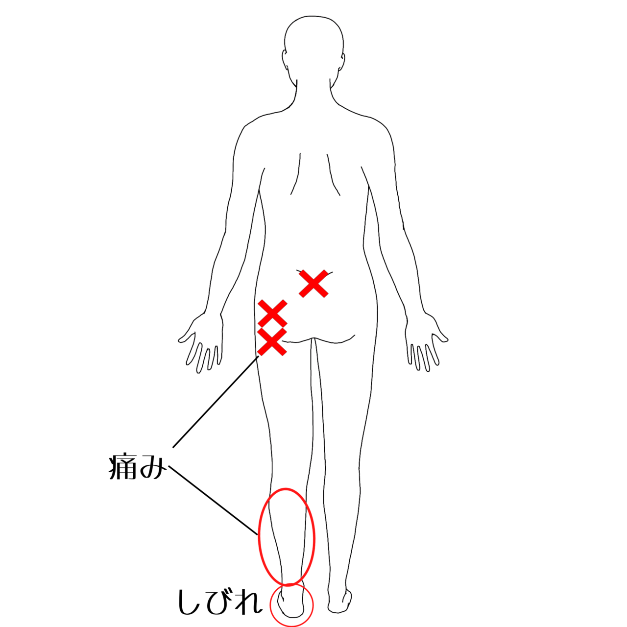 坐骨神経痛の痛みの部位イラスト
