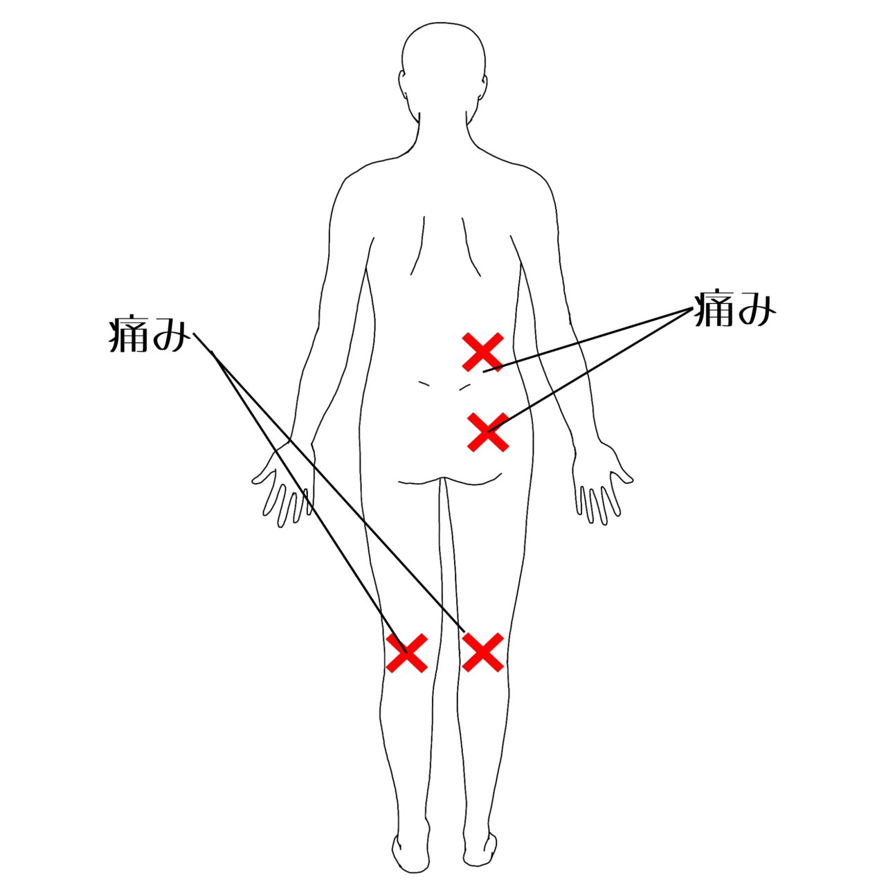坐骨神経痛の痛みの部位イラスト