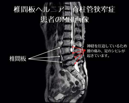 脊柱管狭窄症、坐骨神経、腰椎椎間板ヘルニア